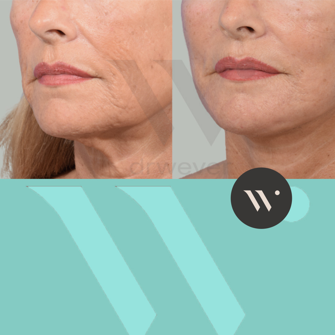 Dokter Wever - facelift en halslift