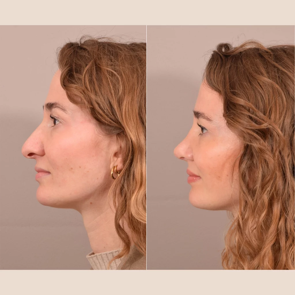 hoe kan ik mijn grote neusgaten verbergen?