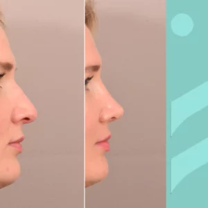 mijn neus heeft een gekke vorm, wat kan ik doen met plastische chirurgie?