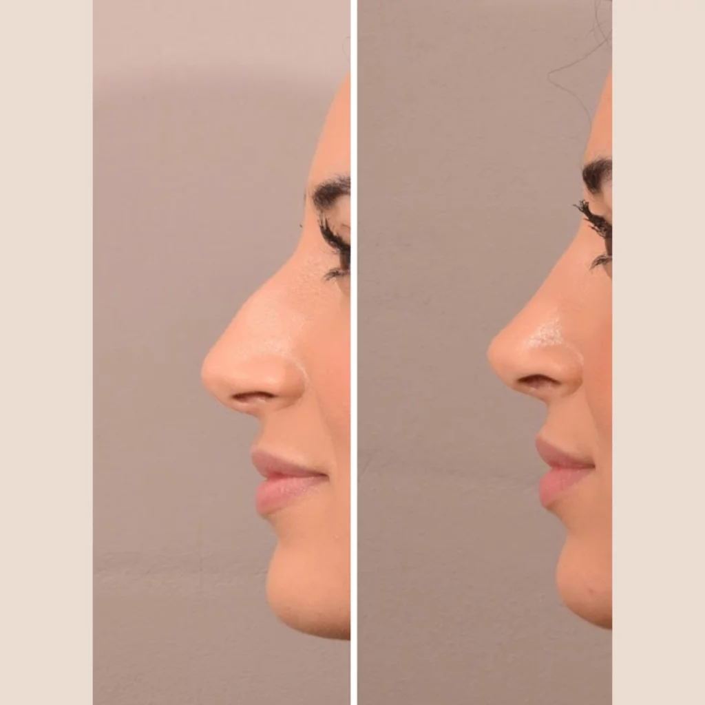 grote neus verkleind