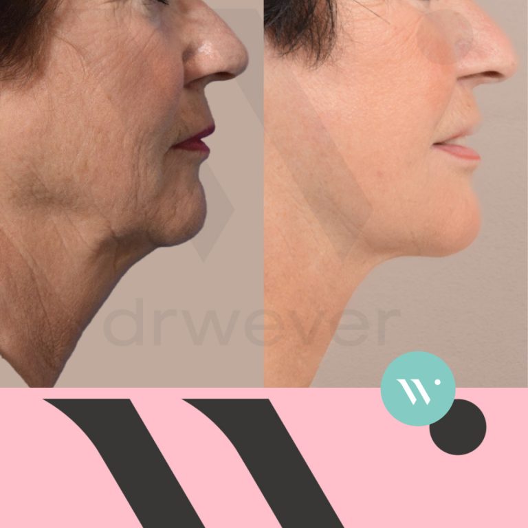 Dokter Wever - facelift en halslift